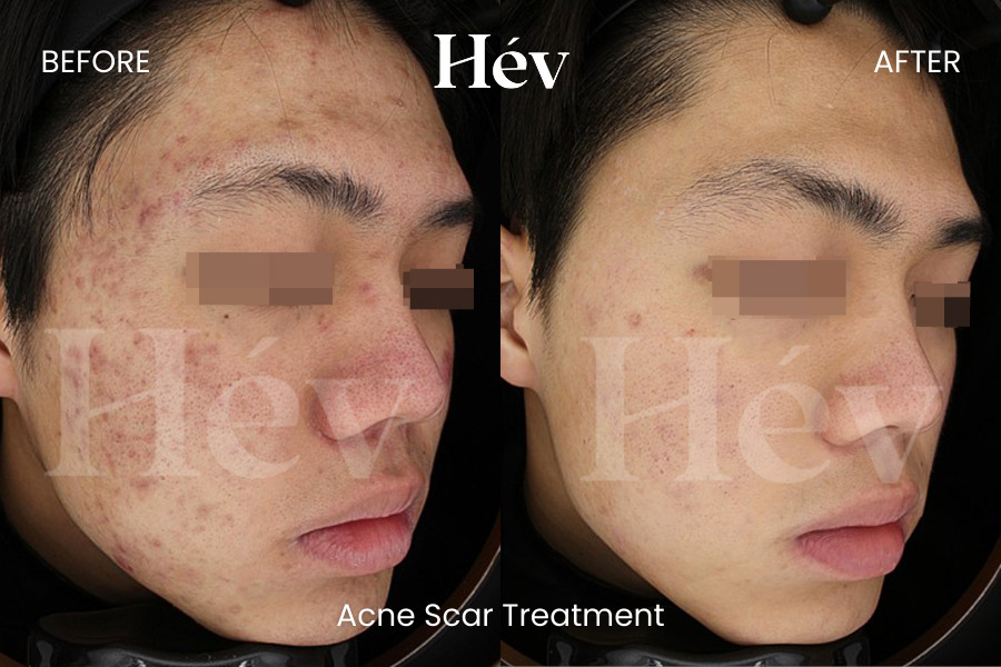 acne-scar-treatment-before and after