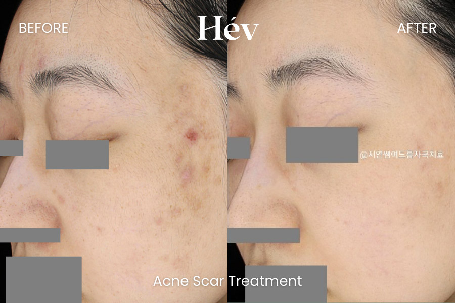 acne-scar-treatment-before and after