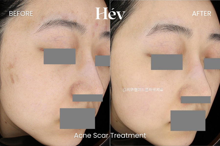 acne-scar-treatment-before and after
