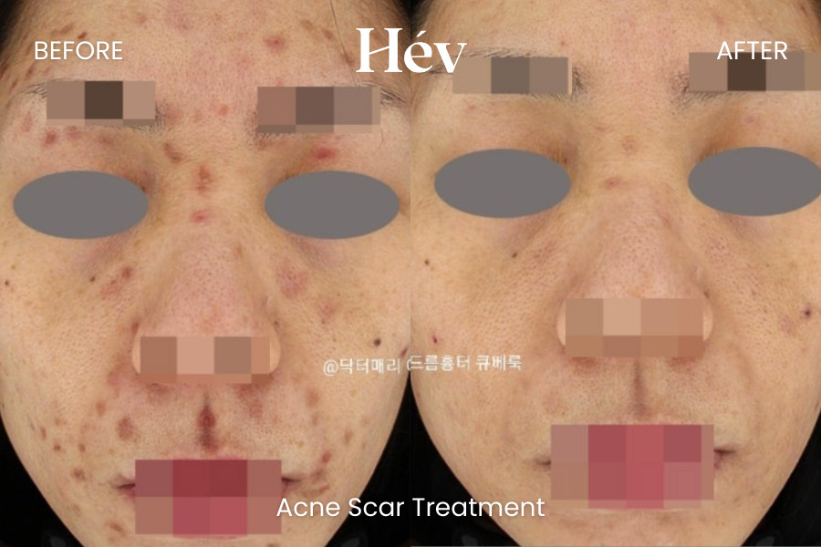 acne-scar-treatment-before and after