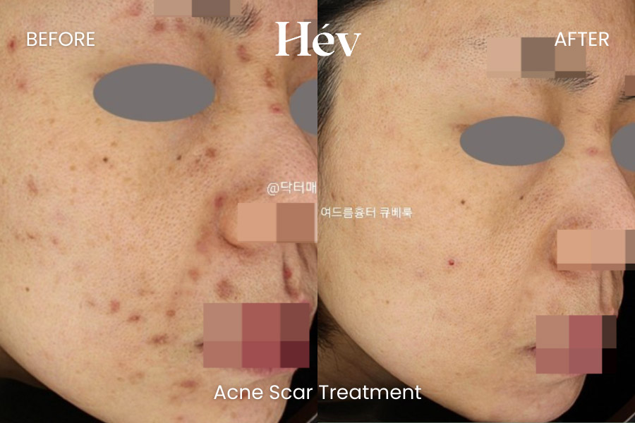 acne-scar-treatment-before and after