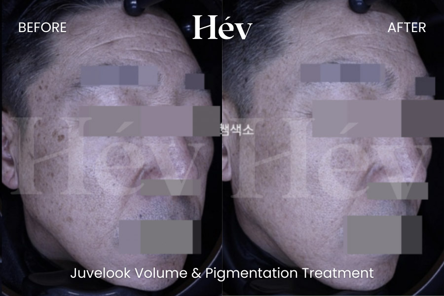 juvelook-volume-pigmentation-treatment before and after