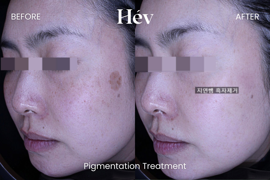 pigmentation-treatment before and after
