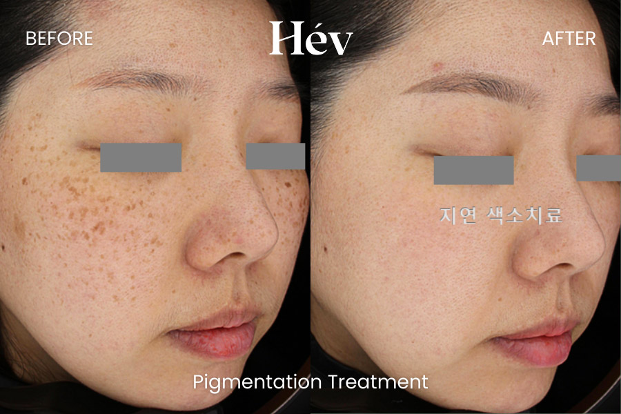 pigmentation-treatment before and after