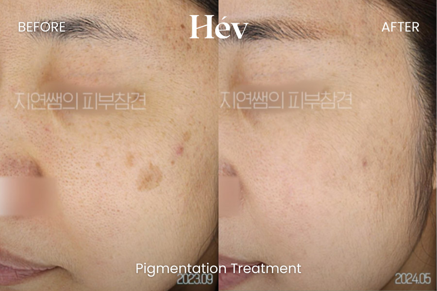 pigmentation-treatment before and after