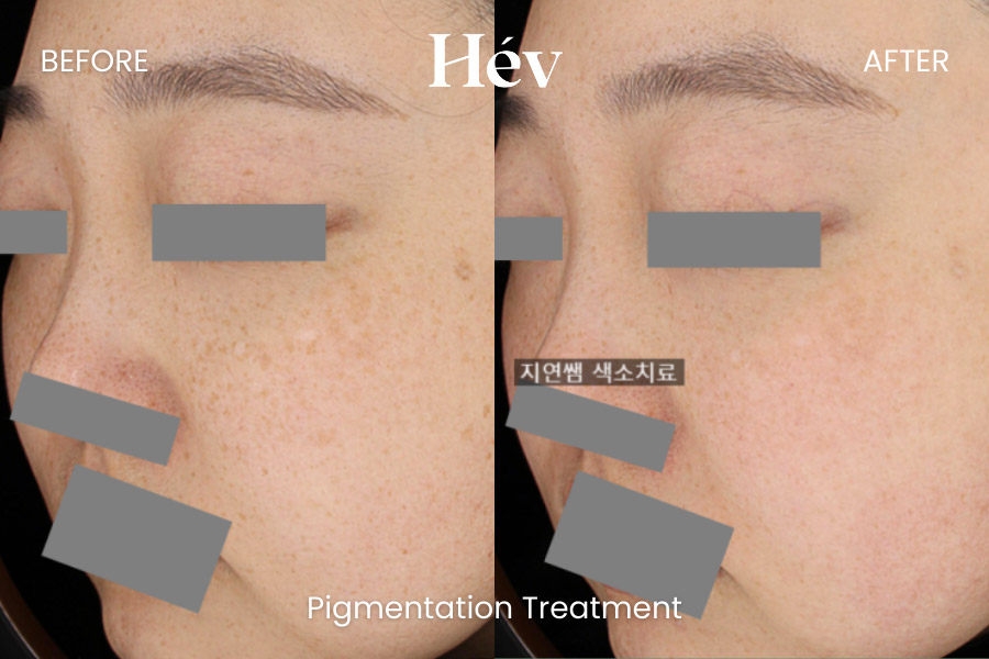 pigmentation-treatment before and after