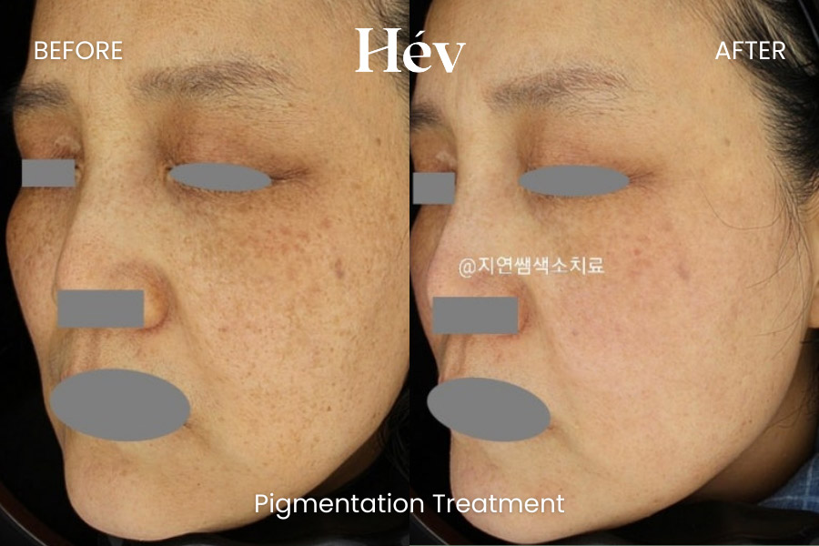 pigmentation-treatment before and after