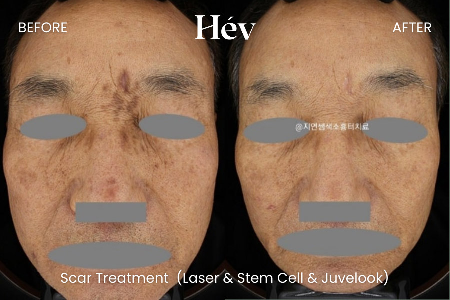 scar-laser-stem-cell-treatment before and after