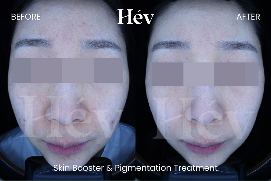 skin-booster-pigmentation-treatment before and after
