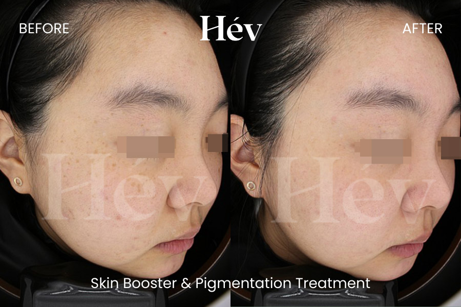 skin-booster-pigmentation-treatment before and after