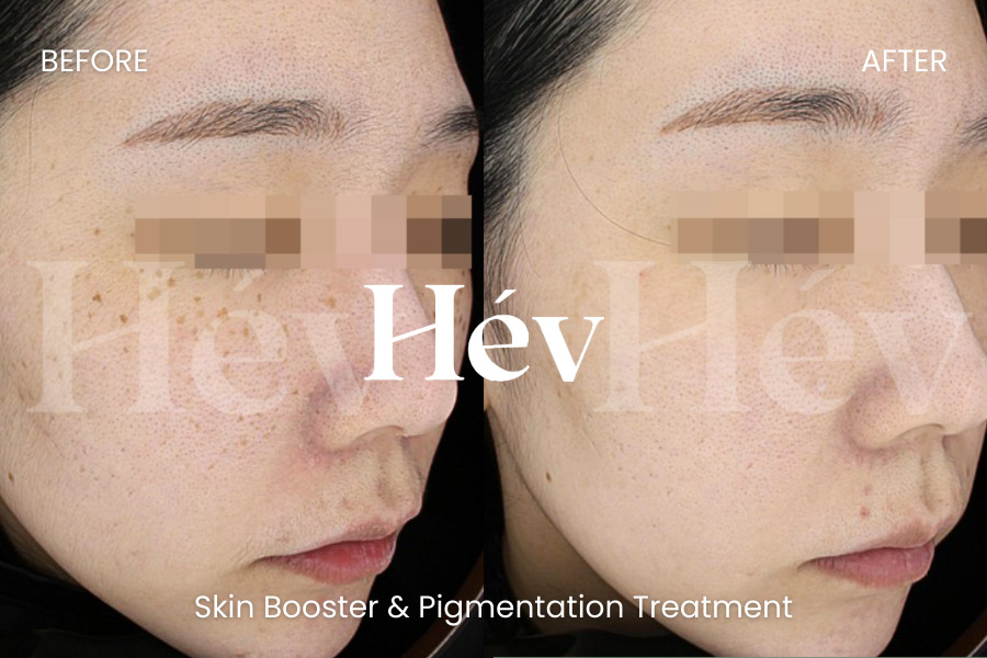 skin-booster-pigmentation-treatment before and after