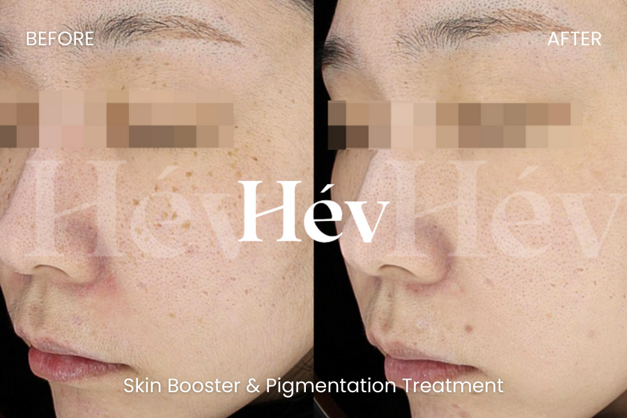 skin-booster-pigmentation-treatment before and after
