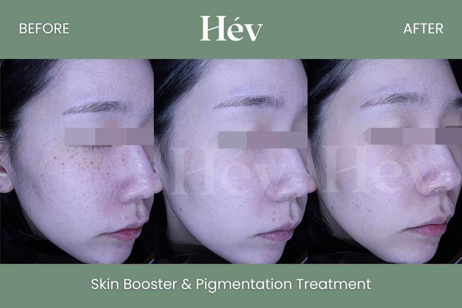 skin-booster-pigmentation-treatment before and after