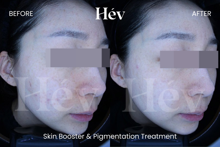 skin-booster-pigmentation-treatment before and after
