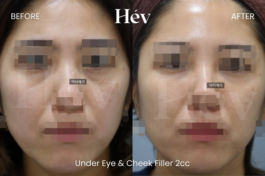 under-eye-cheek-filler before and after