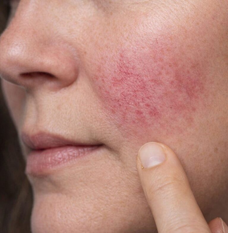 Dermal Filler Side Effects & Aftercare: A Guide for Medical Tourists in Korea