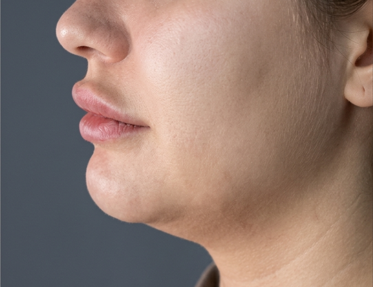 Double Chin Fat-Dissolving Injections in Korea: NUVIJU vs Contouring Injections