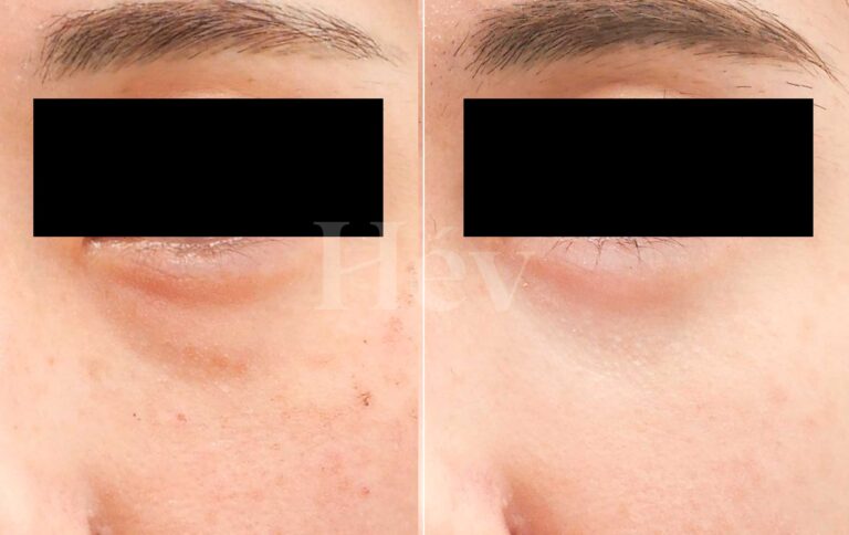 Collagen Booster Juveacell Side Effects and Safety: An Honest Dermatologist’s Guide